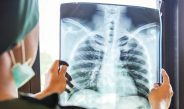 La detección oportuna de cáncer de pulmón salva vidas